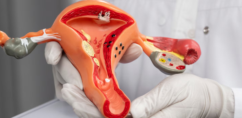 Hysterectomy 