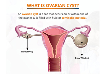 Best gynae Doctor in South Delhi