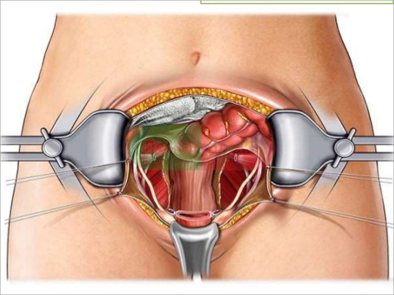  Best Hysterectomy Doctor in Delhi