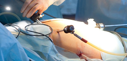 Laparoscopic Surgery - Dr Nisha Ohri 